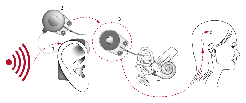 Funktion der Cochlea-Implantate