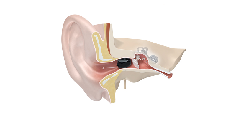 3D-Modell eines IIC-Hörgerät