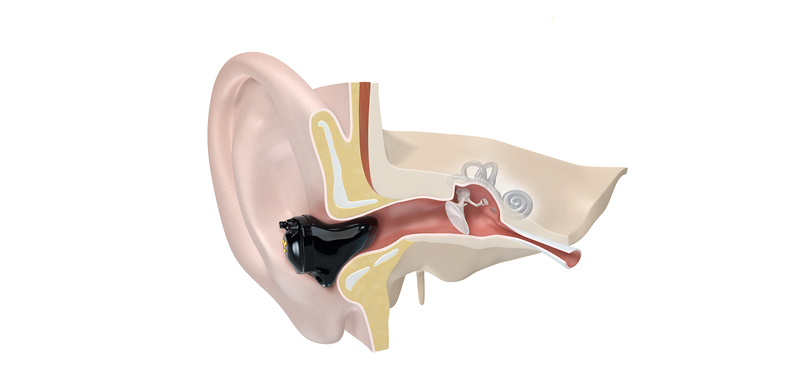 3D-Modell eines ITC-Hörgerät