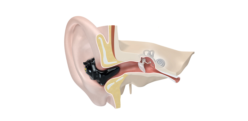 3D-Modell eines ITE-Hörgerät